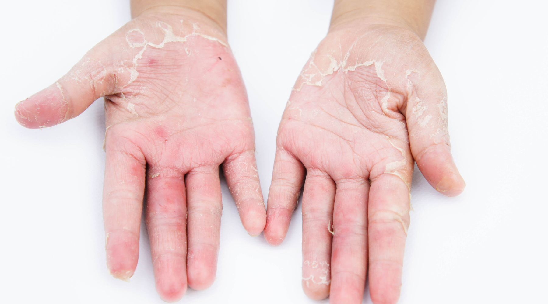 Remedy for dry hands 2025 and feet